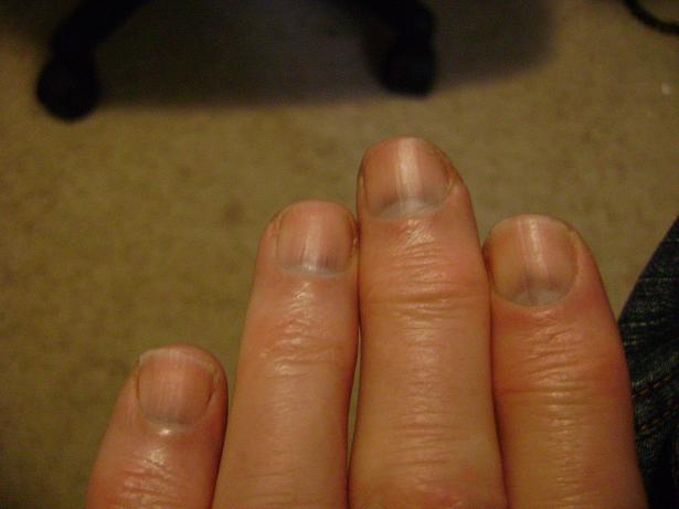 White Spots Nails